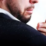 10 Natural Ways to Get Rid of Dandruff Homepage