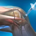 Viscosupplementation –Offering an Effective Solution to People Suffering from Joint Pains Homepage