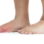 Prevent Gout by Avoiding these Foods Homepage