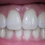 4 Easy Ways to Beat your Sensitive Gums and Teeth Homepage