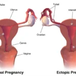 Ectopic Pregnancy- Causes, Signs and Symptoms, and Treatment Homepage