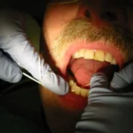 Treating Bleeding Gums at Home Homepage