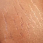 Here Are Tips On How To Get Rid Of Your Stretch Marks Naturally Homepage