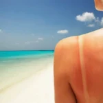 At Home Remedies For Sunburn Homepage