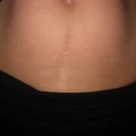 Getting Rid of the Belly Bulge after Getting C-Section Homepage