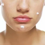 Three Ways to Stop a Pimple from Growing Homepage