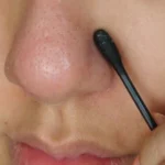 Three Home Remedies to Get Rid of Blackheads Homepage