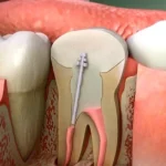 Why Getting a Root Canal Might Actually be a Bad Idea Homepage