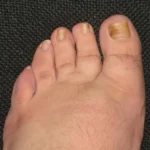 How to Treat Nail Fungus Naturally? Homepage