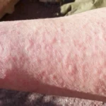 Home Remedies for Blistering Rash on Your Hands Homepage