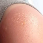 Sunburn Blister: Facts and Home Remedies Homepage