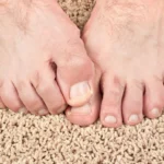 Tips on Eliminating Skin Fungus Homepage