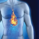 Surprising Causes of Acid Reflux Homepage