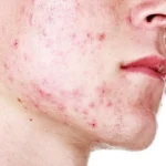 Acne Causes, Symptoms, Home Remedies Homepage