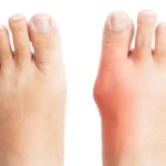 Tips on Beating Bunions Naturally Homepage