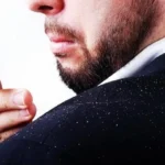 Dandruff Causes, Symptoms, Remedies Homepage