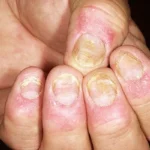 Home Remedies for Nail Psoriasis Homepage