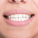 How to Treat Gingivitis Naturally Homepage