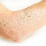 Hyperkeratosis: Causes, Symptoms and Treatment Homepage