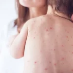 Measles Causes and Remedies Homepage