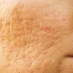 Home Remedies for Acne Excoriee Homepage