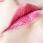 Remedies for Angular Cheilitis (Inflammation of the Corners of the Mouth) Homepage