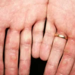 Home Remedies for Itchy Blisters on the Fingers and Palms Homepage