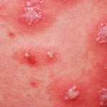 Home Remedies for Pustular Psoriasis Homepage