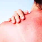 Skin Burns and Prevention Homepage