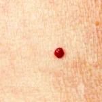 Natural Remedies for Cherry Angiomas Homepage