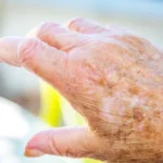 Age Spots Begone with These Natural Remedies Homepage