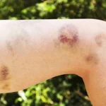 Bruises Causes and Remedies Homepage