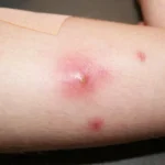 Pus Causes, Symptoms and Remedies Homepage