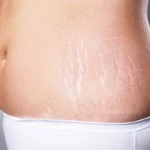 Stretch Marks Causes and Remedies Homepage