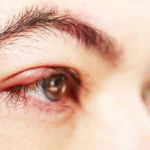 Stye Causes and Remedies Homepage