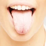 White Tongue Causes and Symptoms Homepage
