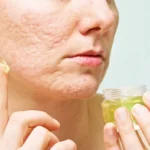 Steps to Making Your Own Acne Gel Homepage