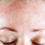 Natural Remedies for Flaking Skin on Face Homepage