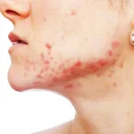 Home Remedies for Bleeding Acne Homepage