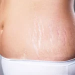 Ayurvedic Remedies for Stretch Marks Homepage