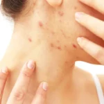 Acne Mechanica: What It is and How to Get Rid of It Homepage