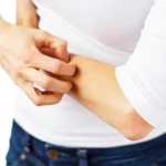 What You Need to Know About Plaque Psoriasis Homepage