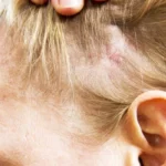 Remedies to Cure Hair Fungus Homepage