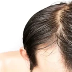 Ayurvedic Remedies for Oily Scalp Homepage