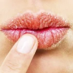 Homemade Recipes to Treat Chapped lips Homepage