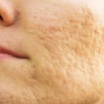 Remove and Reduce Your Facial Scars Naturally Homepage