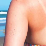 Sunburn: Is It a First-Degree or Second-Degree Burn? Homepage