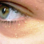 How to Remove Cholesterol Deposits Around the Eyes Homepage