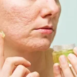 How to Make a Scar Removing Cream Using Two Common Ingredients Homepage