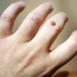 Everything You Need to Know About Periungual Warts Homepage